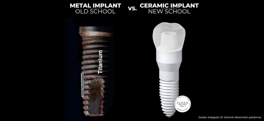 Implantat Vergleich